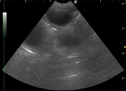 超音波にて確認された拡張した子宮